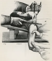 Resezione della spalla, da 