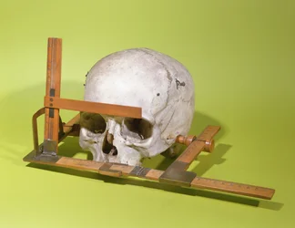 Teschio in un goniometro facciale costruito da Paul Broca