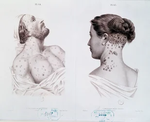 Sintomi della sifilide negli uomini e nelle donne, da un libro medico, c.1850-60