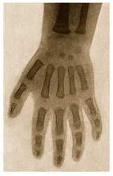 Radiografia della mano di un bambino c.1890