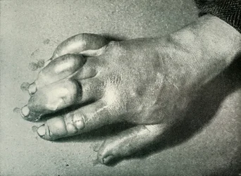 La mano congelata del Dr. Atkinson, 5 luglio 1911, 1913