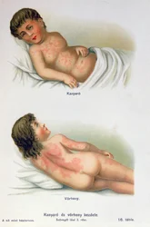 Morbillo e scarlattina, da un libro medico di famiglia, c.1900