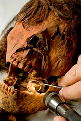 Il Dr. John Varano della Tulane University esamina i denti della mummia.