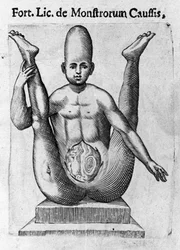 Mostro umano: una creatura con un enorme cranio, con visceri apparenti. Incisione da De monstrorum natura, causis et differentiis di Fortunio Liceti (1577-1656), scienziato italiano. 1646