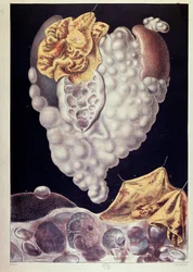 Cancro - da Cruveilhier