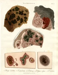 Cambiamenti patologici della pelle: Porriga e Ecthyma