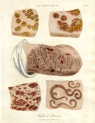 Cambiamenti patologici della pelle: Varietà di psoriasi
