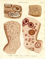 Condizioni patologiche della pelle: Schurigie; Pelle lebbrosa; Pallade e Impetigine