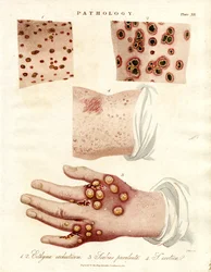 Malattie della pelle: Ecthyma; scabbia purulenta e vaiolo