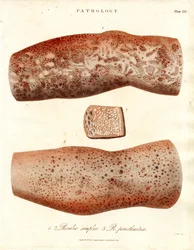 Eruzioni cutanee - Roseola simplex e Roseola paristhmitica