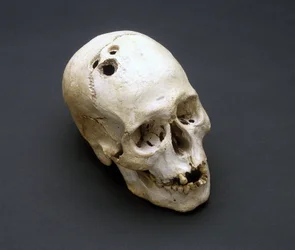 Cranio trapanato dell