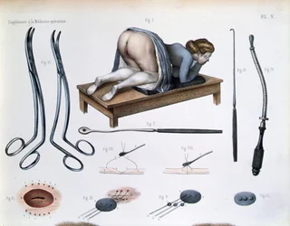 Operazione su una fistola vescico-vaginale, da 