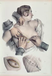 Operazione su un tumore canceroso, da 