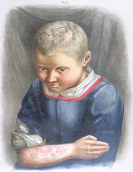 Favus, da un libro di Daniel Cornelius Danielssen (1815-94) 1892