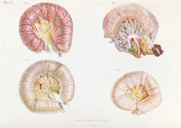 La superficie esterna degli intestini infettati dal colera, da Anatomie Pathologique du Cholera Morbus, di Nikolai Ivanovich Pirogov (1810-81) pubblicato a San Pietroburgo, 1849