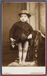 Malattie, Rachitismo Bambino con rachitismo