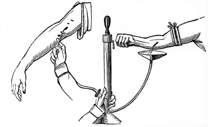 Trasfusione di sangue da persona a persona, 1833