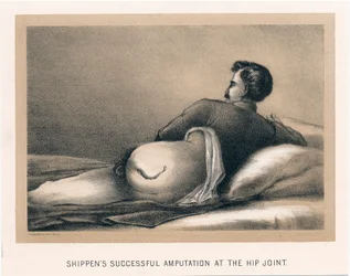 Amputazione riuscita di Shippen all