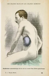 Milza ingrandita tipica di un paziente con malaria, c1890