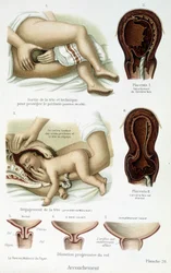 Parto - tavola scientifica, fine XIX secolo