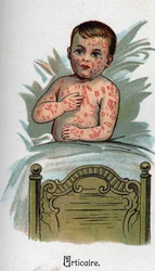 Malattie infantili: Orticaria. In “La nuova medicina naturale” di F.E. Bilz