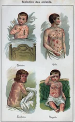 Malattie dei bambini: Orticaria, morbillo, scabbia, scarlattina. In "La nuova medicina naturale" di F.E. Bilz