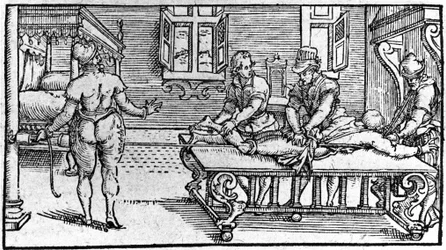 Riduzione di una lussazione, -in "Trattato Medico" di Ambroise Paré, circa 1560