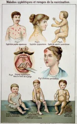 Tavola illustrativa delle diverse forme di malattie sifilitiche e dei pericoli della vaccinazione - in "Bilz, Natural Medication", fine XIX secolo