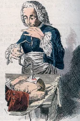 La trapanazione. Stampa del XVIII secolo.