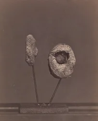 Articolazione del ginocchio escissa. Una palla di moschetto rotonda nel condilo interno del femore destro