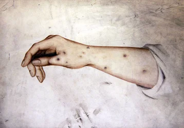 Studio di un avambraccio con condizione della pelle, c.1850